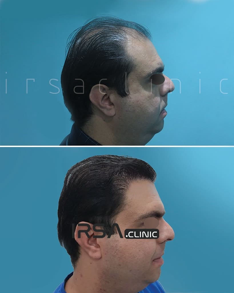 hair transplant price in Iran