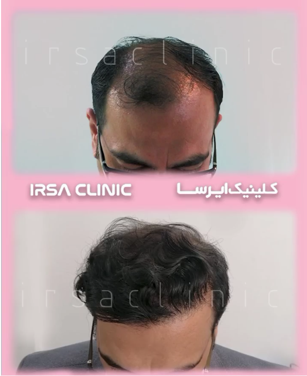 hair transplant surgery in Iran 2022