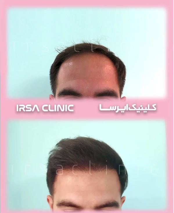 best hair transplant clinic in Iran