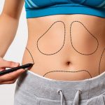 What is Liposuction or Tummy Tuck?