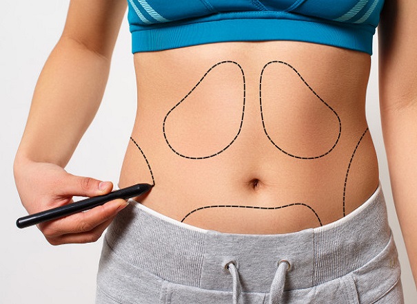 What is Liposuction or Tummy Tuck? - کلینیک پوست، مو و زیبایی ایرسا