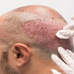 Pre and Post Hair Transplant Care