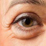 What are the Causes of Bags Under the Eyes?