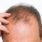 ما هی أسباب تساقط الشعر عند الرجال؟