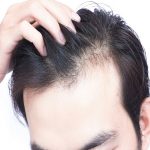الهرمونات و تساقط الشعر