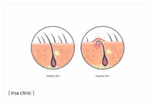 پیشگیری از موهای زیرپوستی