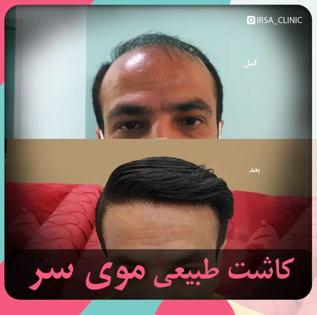 جراحة زراعة الشعر في شيراز ايران 