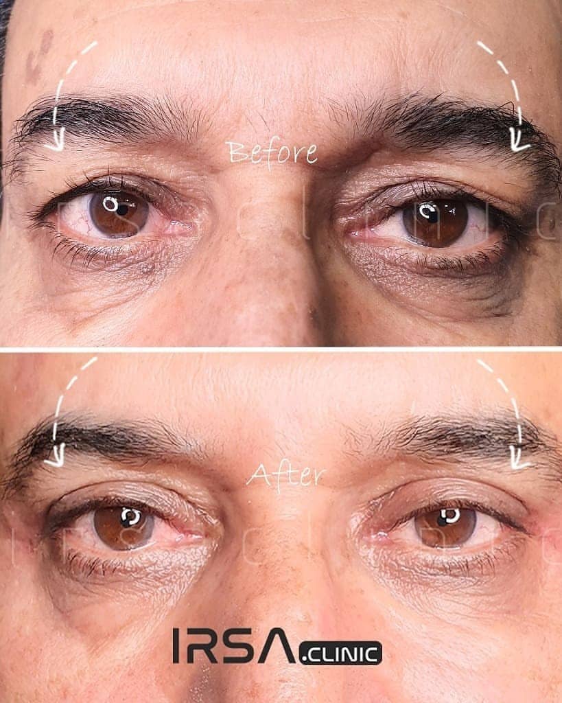 eyelid blepharoplasty cost in Iran