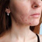 Acne or Hormonal acne:  Reasons and How to Deal with It