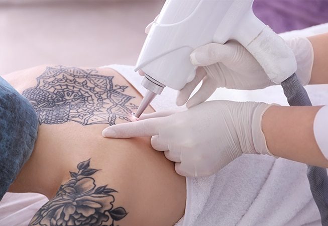 pico-laser-tattoo-removal-amaris-b-clinic