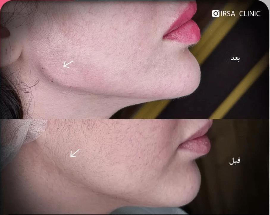 jaw filler injection in Iran 