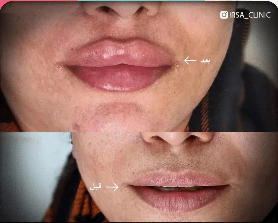 lips filler injection in Iran