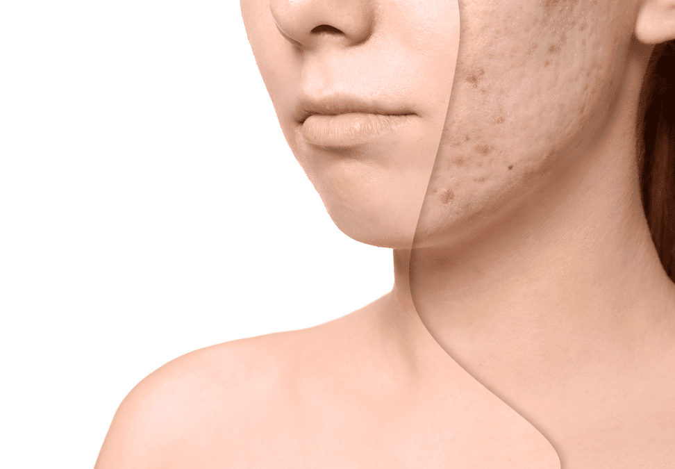 Laser removal of scars and acnes in Shiraz