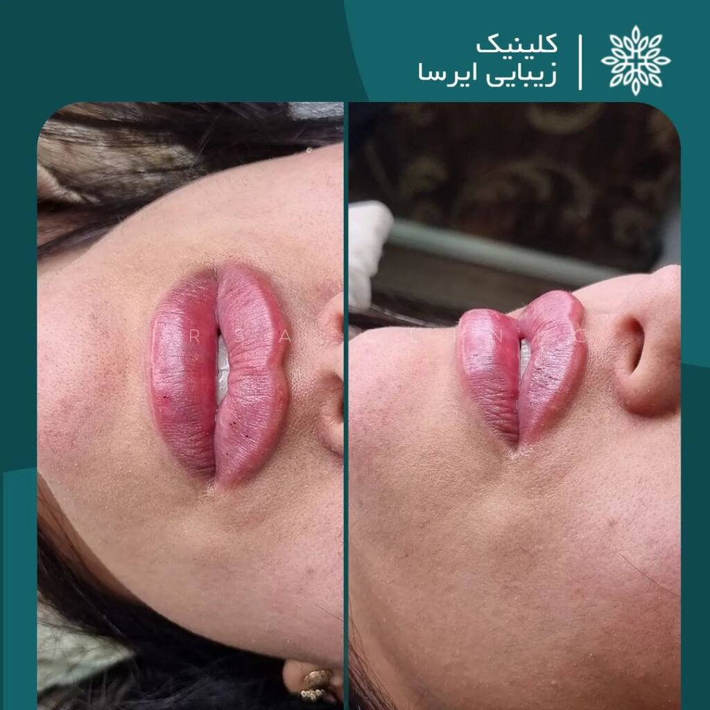 lip filler injection in Iran 