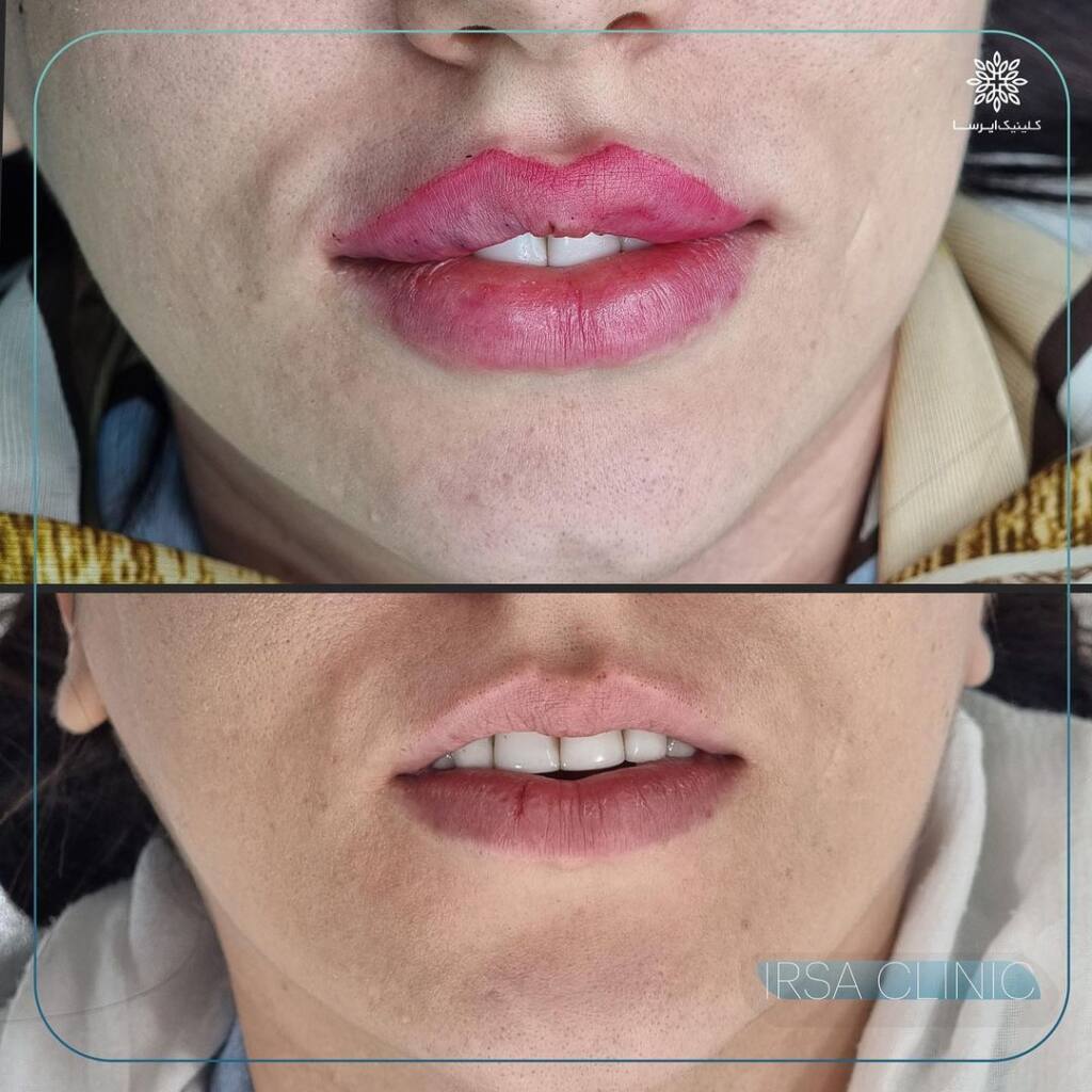 Russian method for lip filler injection  