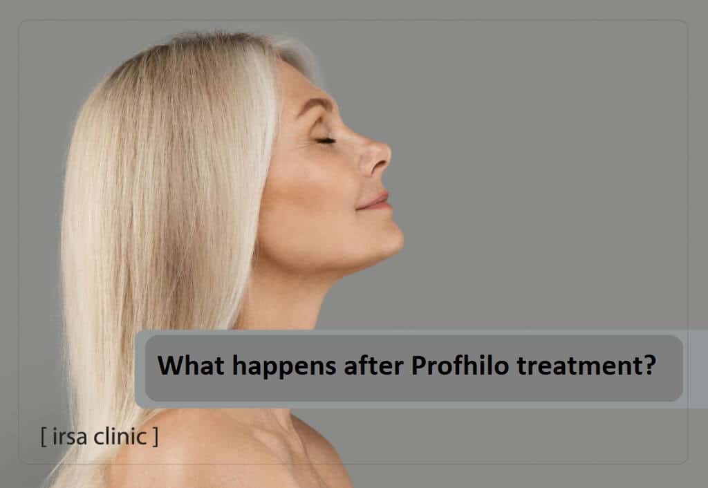 What happens after Profhilo treatment?