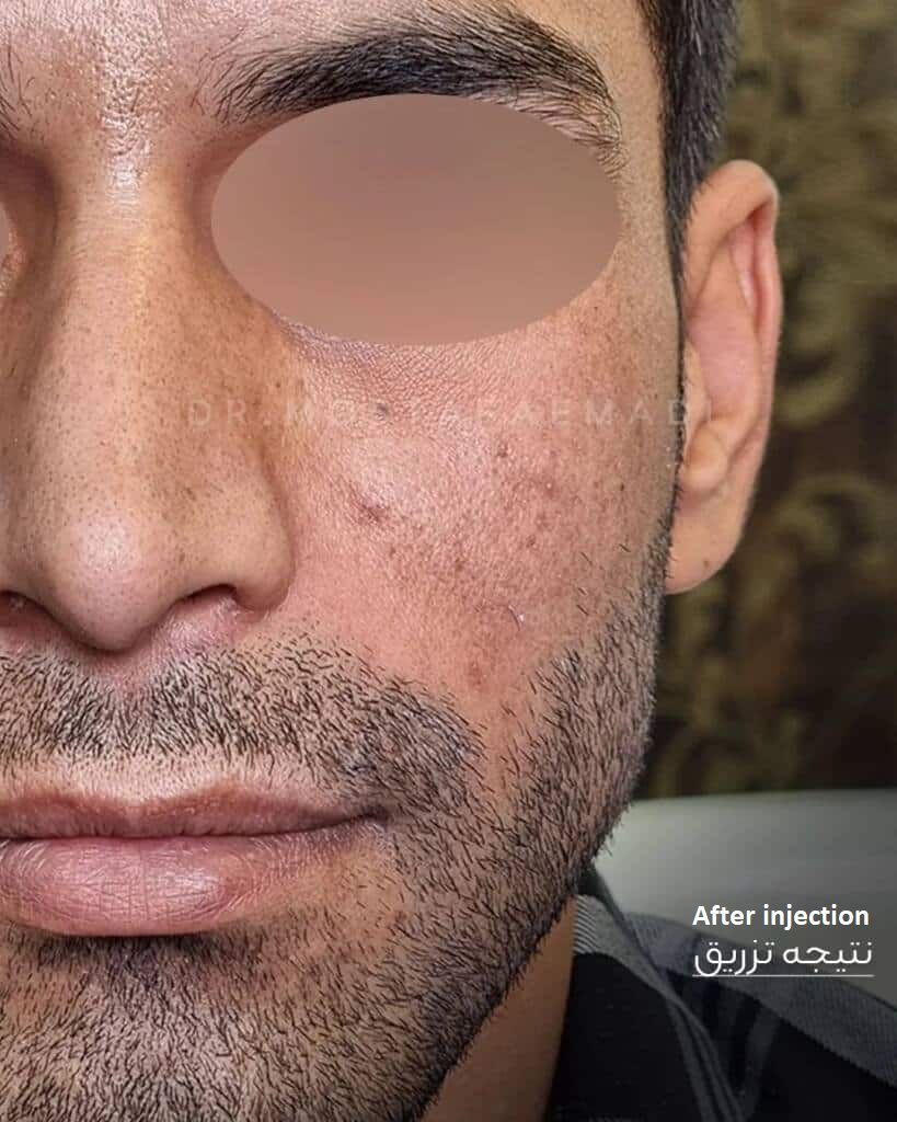Dermal filler injection in Iran 
