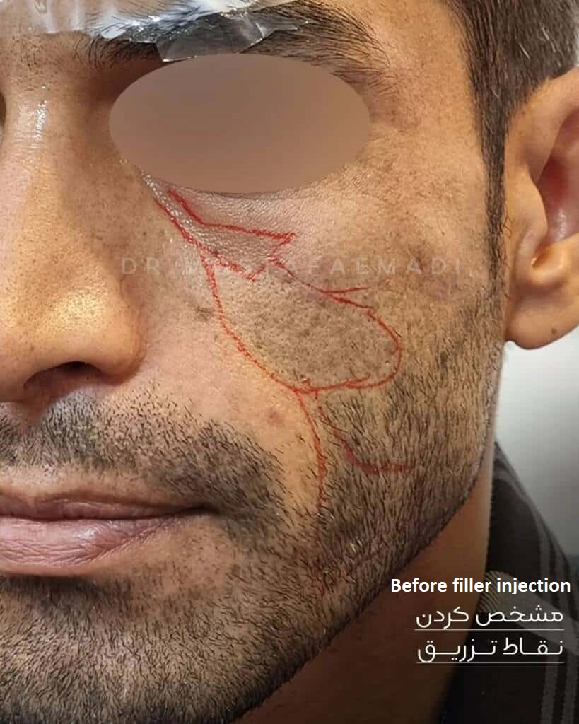 Face filler injection in Shiraz Iran 