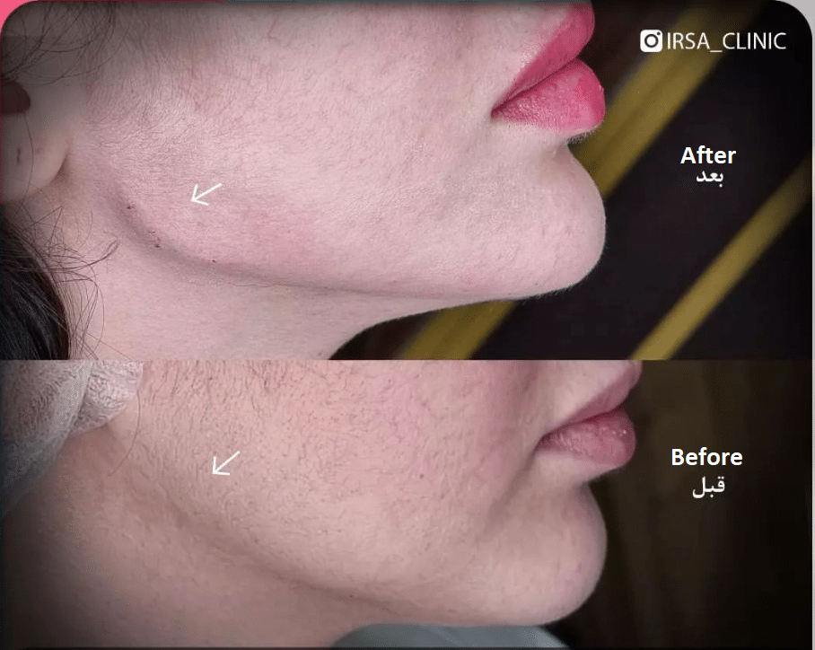 Face contouring in Iran 