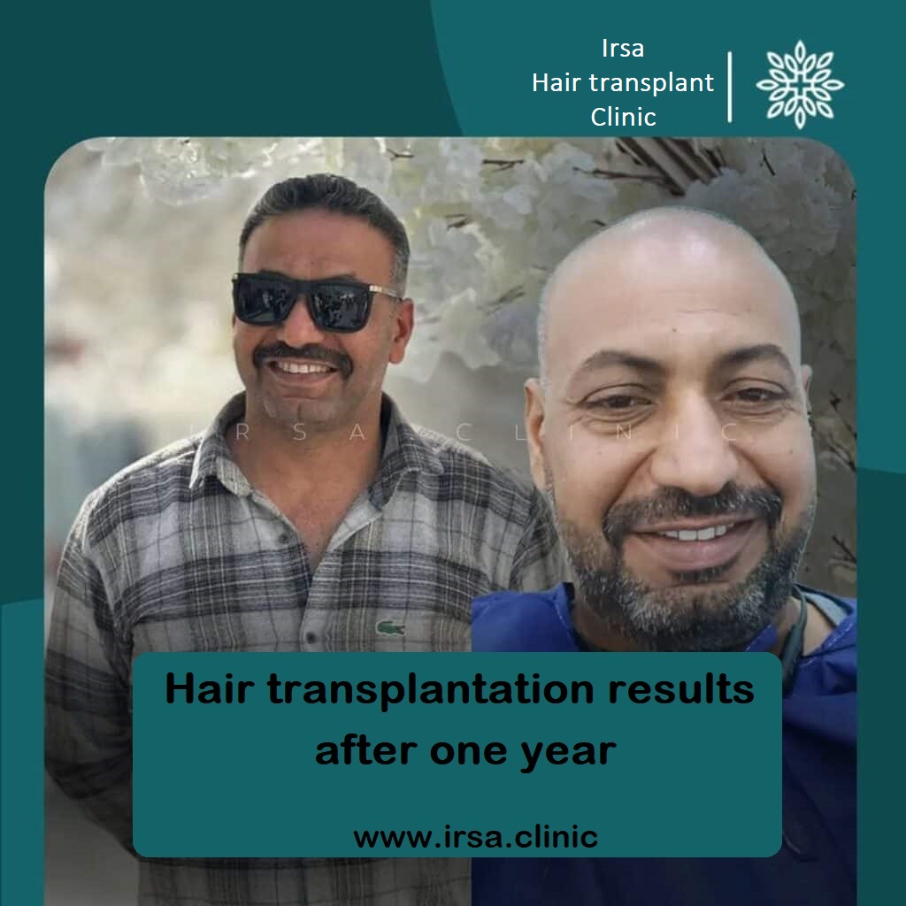 hair transplantation in Iran (Shiraz city)