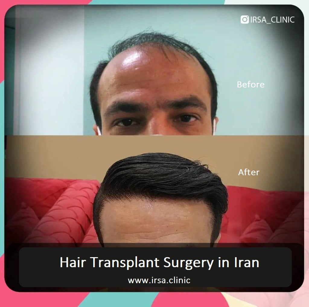 hair transplant clinic in Iran