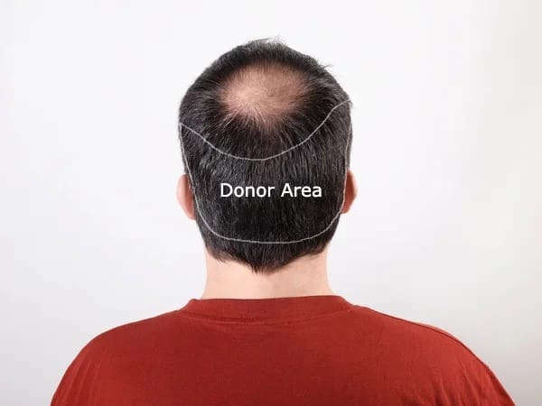 donor-area-hair-transplant--in-Iran