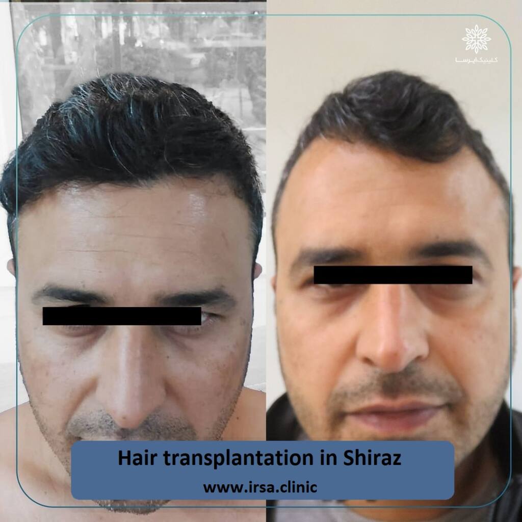 hair transplantation cost in Iran