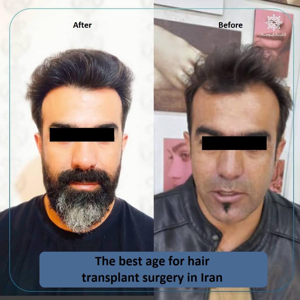 the best hair transplant clinic in Iran