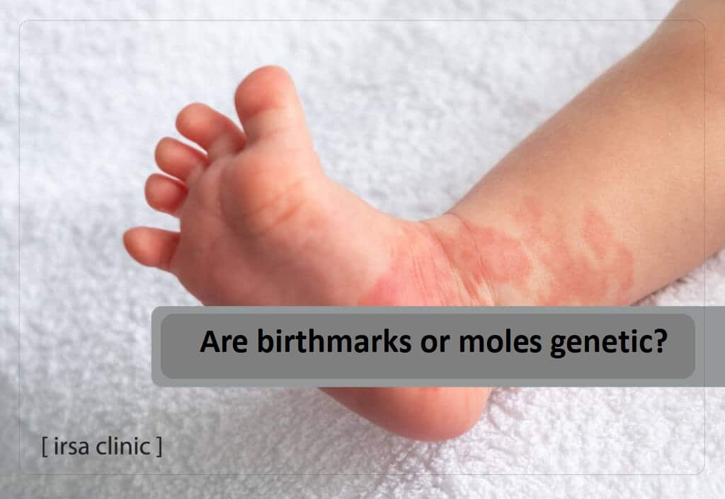 Are birthmarks or moles genetic?