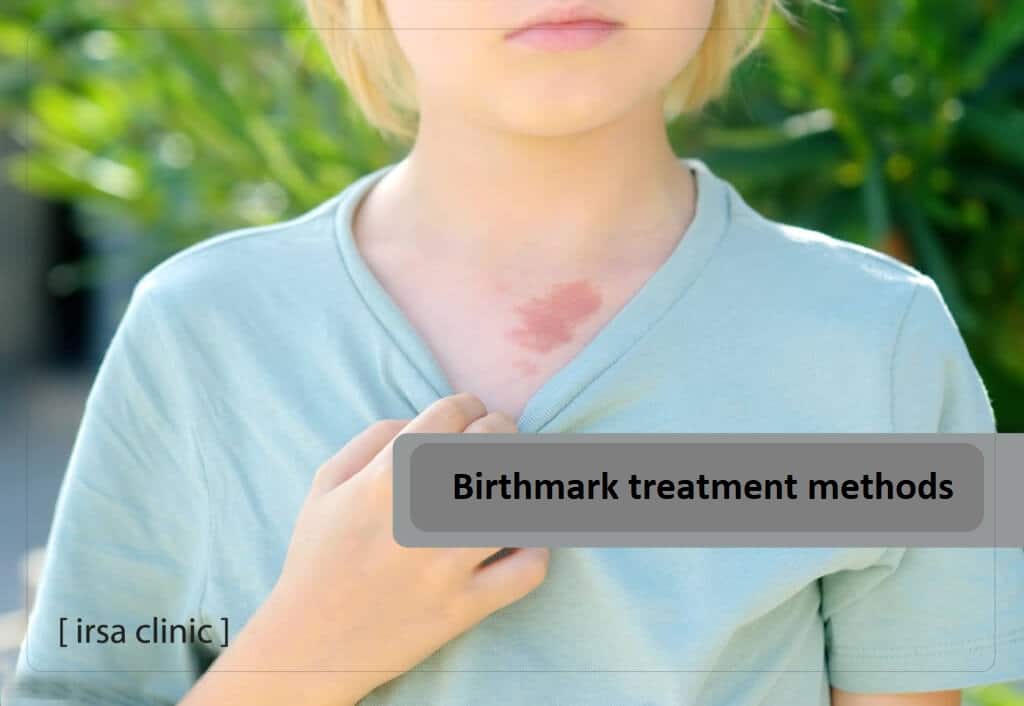 Birthmark treatment methods