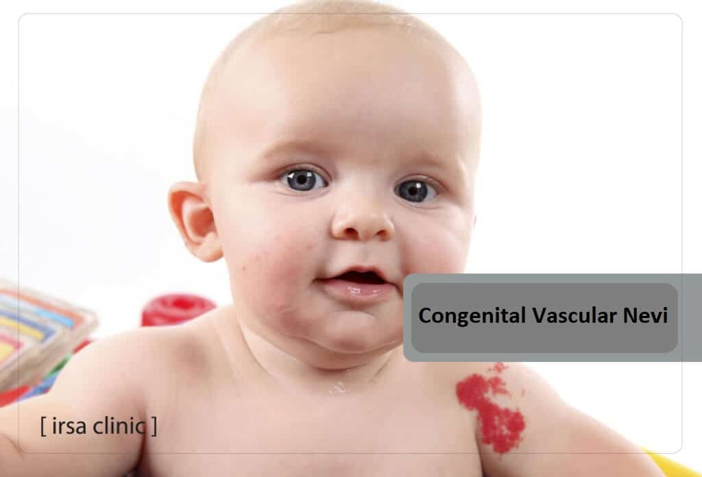 Congenital vascular nevi