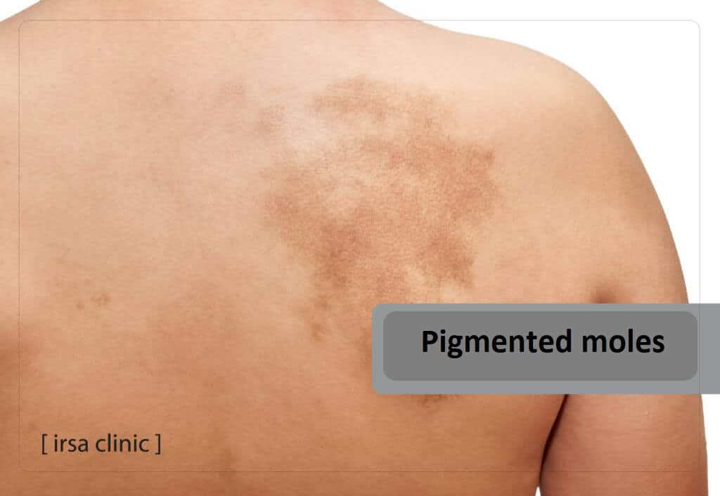 Pigmented moles