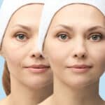 The Difference Between Fat and Filler Injection for Face