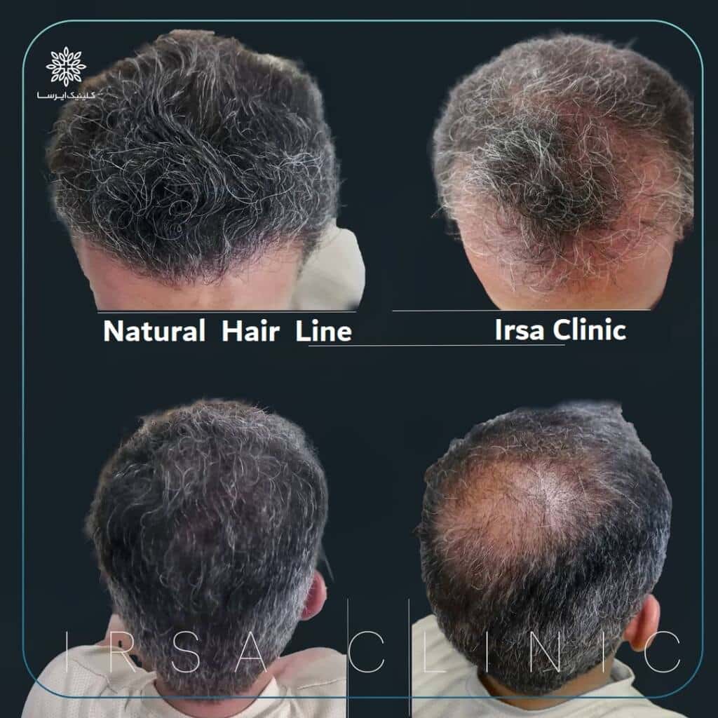 natural hair line, Iran hair transplantation clinic 