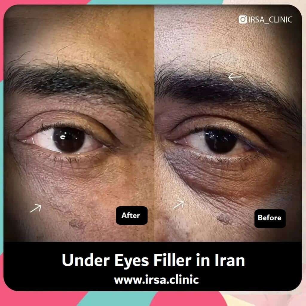 Before and after undereye filler injection in Shiraz