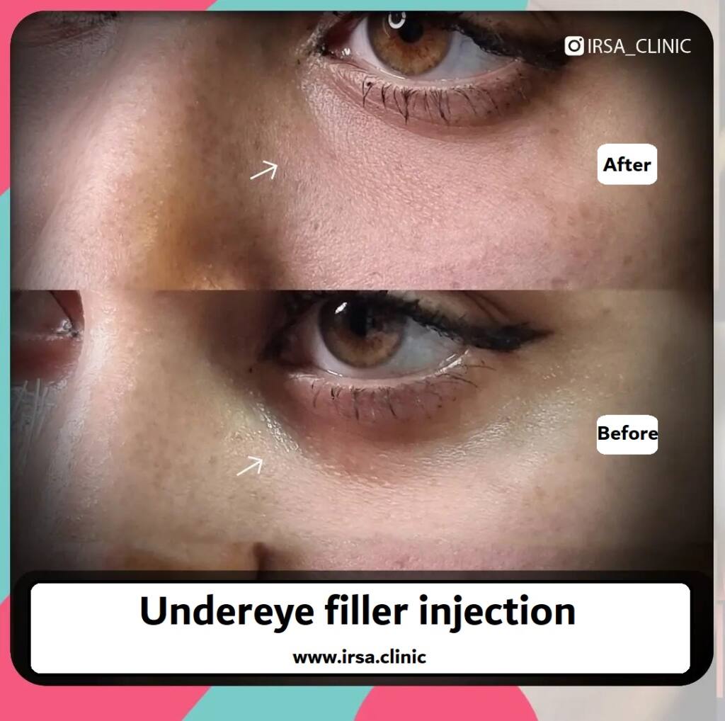 Before and after undereye filler injection in Iran