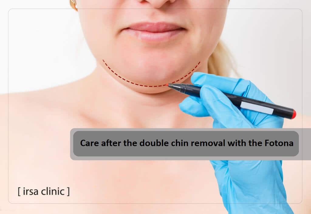 Care after the double chin removal with the Fotona device