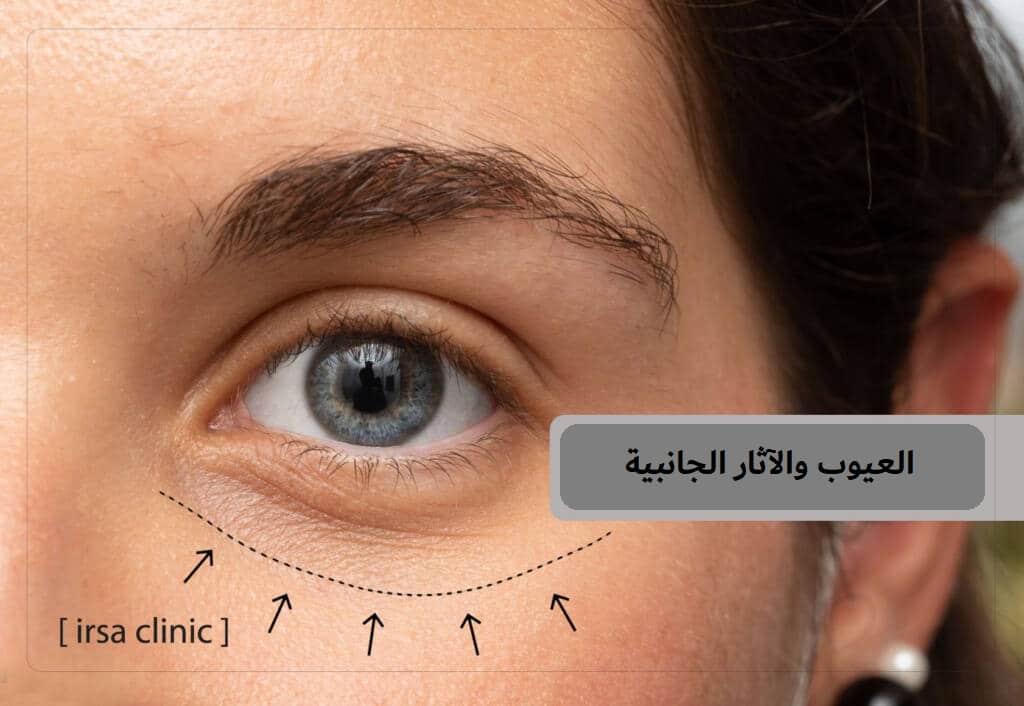 العيوب والآثار الجانبية المحتملة لحقن الفيلر تحت العين في ايران