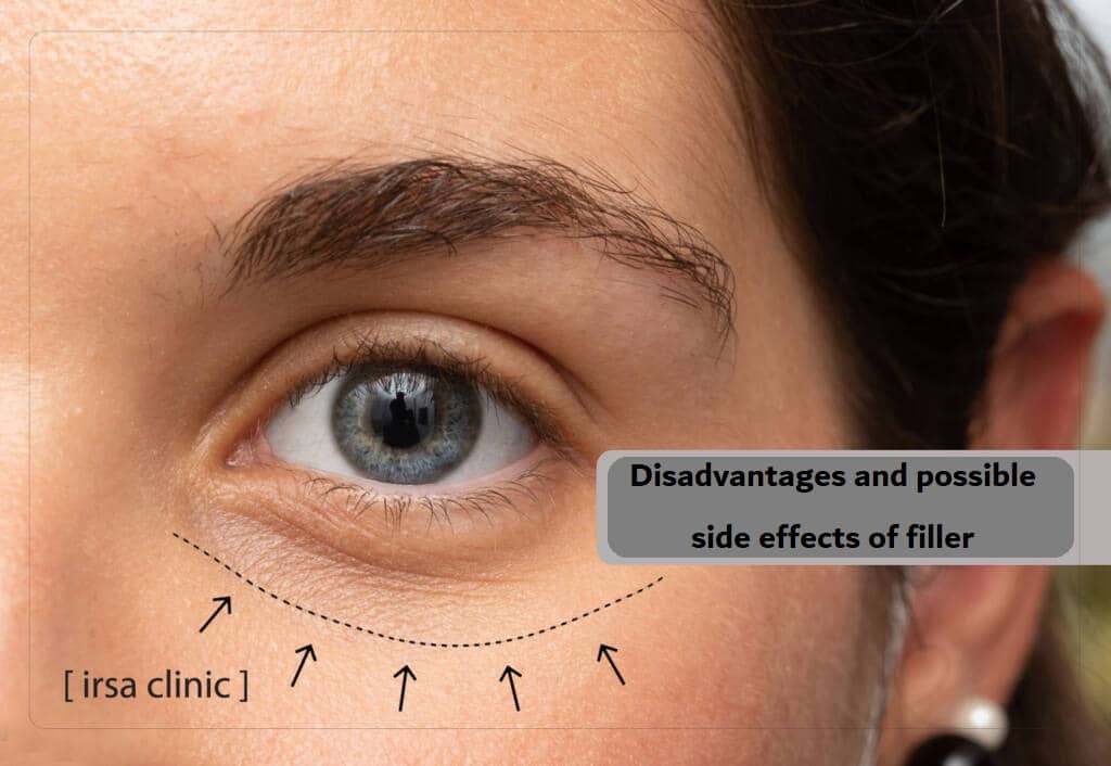 Disadvantages and possible side effects of filler injections under the eyes