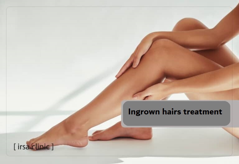 ingrown hairs treatment