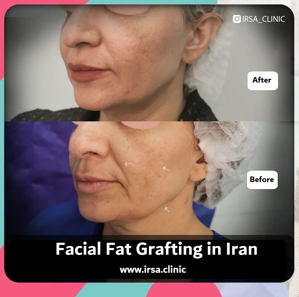 facial fat grafting in Iran