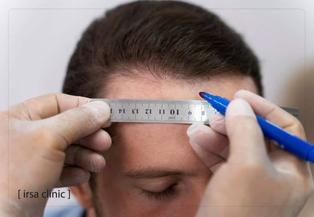 دور زراعة الشعر في علاج تساقط الشعر الناتج عن مشاكل الغدة الدرقية