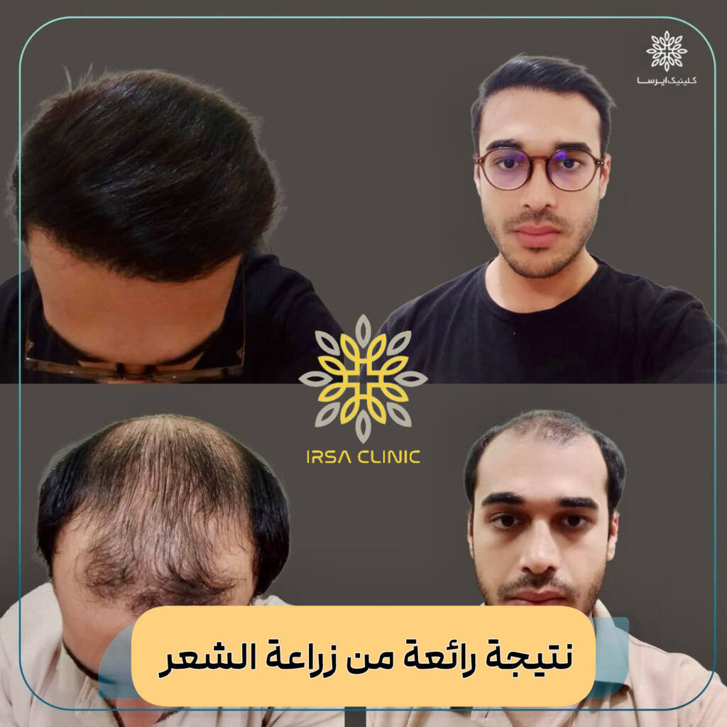 زراعة الشعر في شيراز