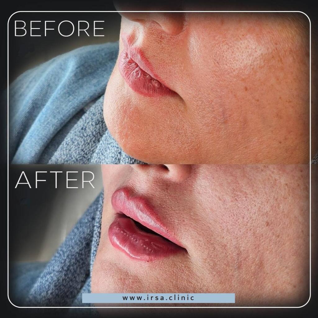 Dermal filler injection for lips in Iran 