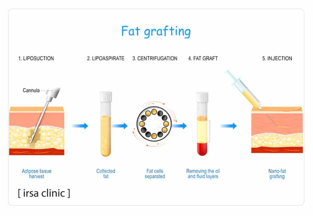 How to treat with fat grafting method