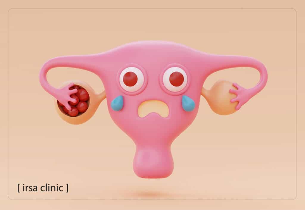 What is Polycystic Ovary Syndrome?