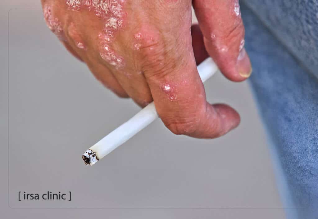 Smoking and specific skin problems