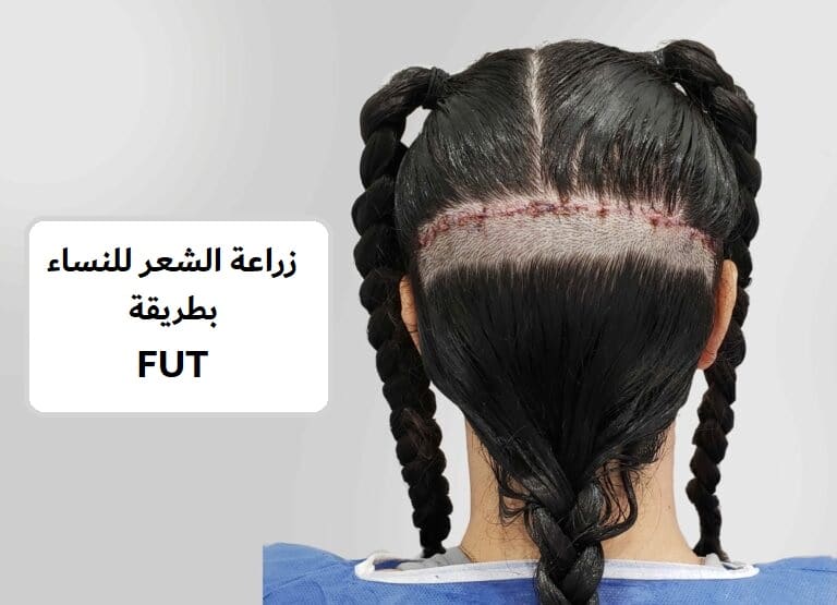 زراعة الشعر للنساء بطريقة FUT