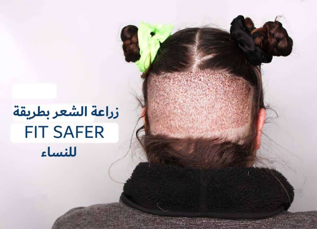 عمليات زراعة الشعر للنساء في ايران