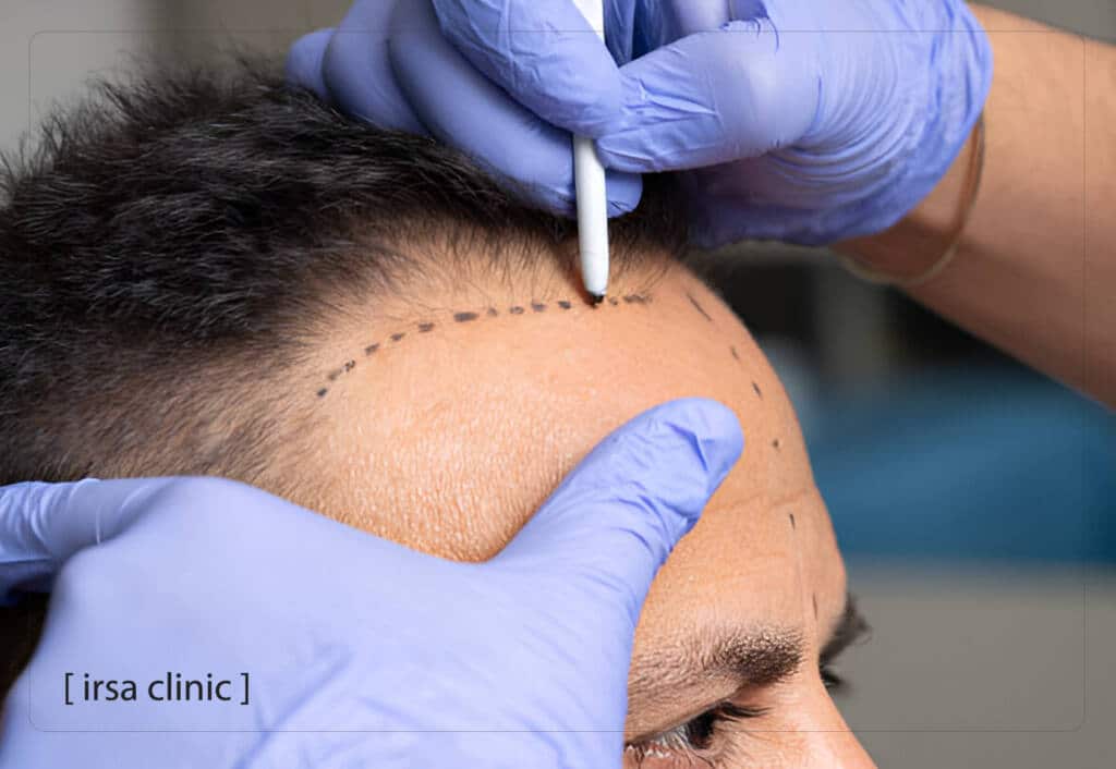 هل يمكن لمرضى التهاب الكبد الوبائي إجراء عملية زراعة الشعر في ايران؟